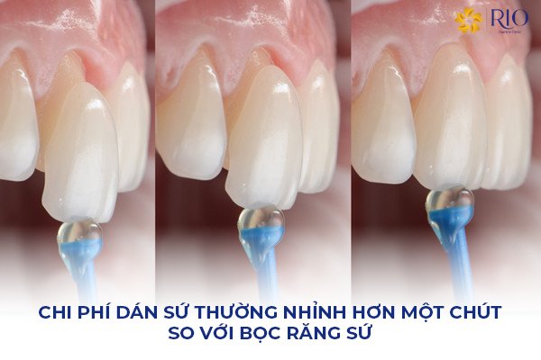 Chi phí dán sứ và bọc răng sứ. Chi phí dán sứ và bọc răng sứ