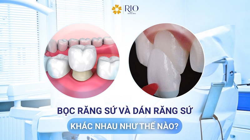 Bọc răng sứ và dán răng sứ khác nhau như thế nào