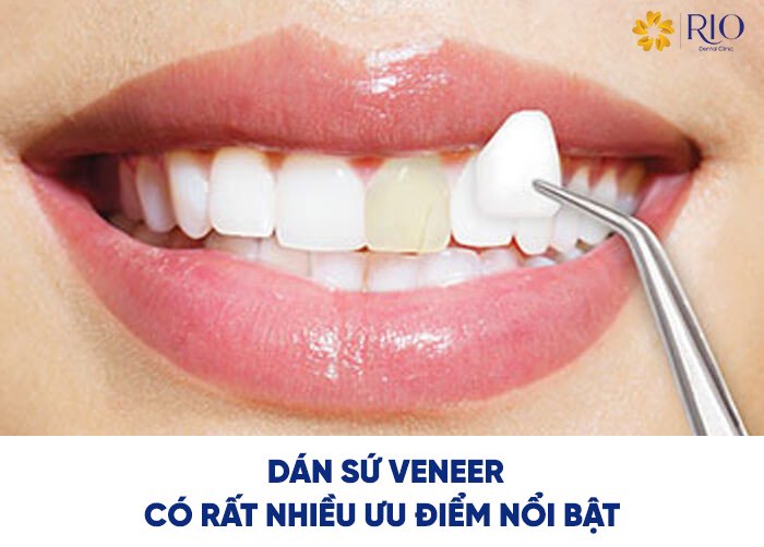 ưu điểm dán răng sứ Veneer