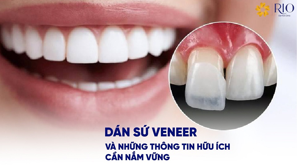 Dán sứ Veneer