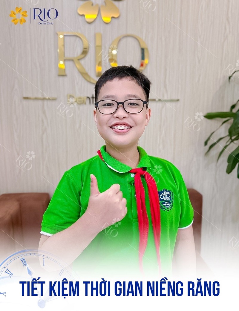 Thời gian niềng răng nhanh