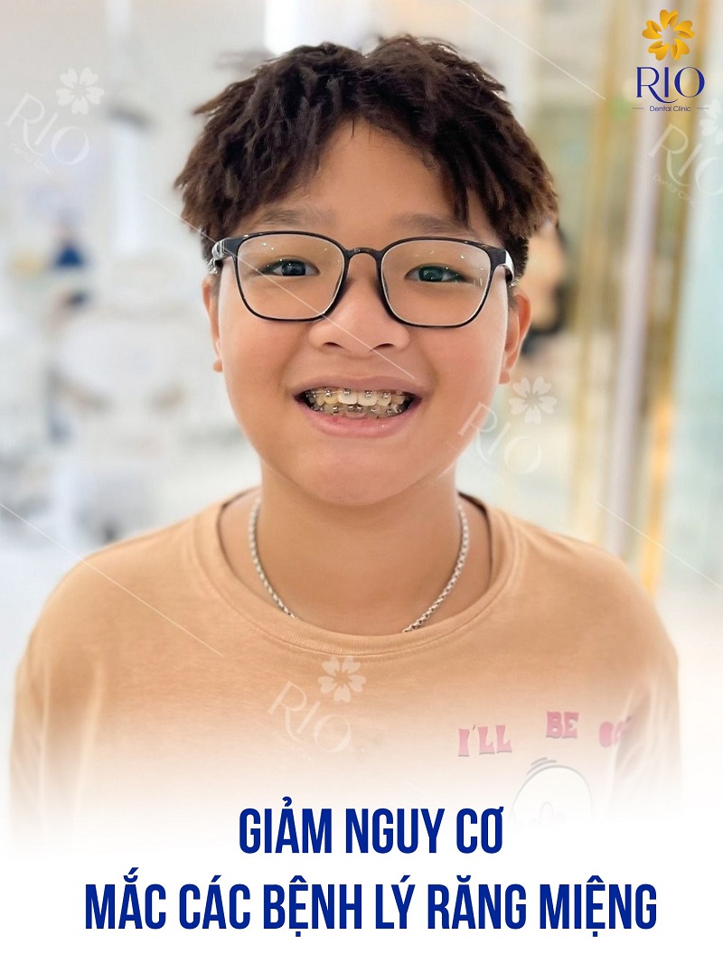 Niềng răng sớm cho trẻ từ 12 tuổi