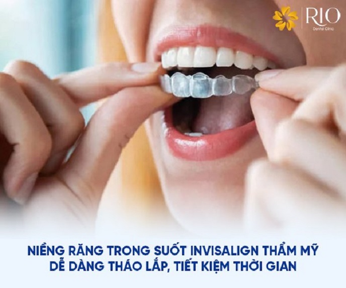 Niềng răng trong suốt có rất nhiều ưu điểm nổi bật