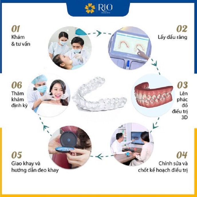Quy trình niềng răng Invisalign