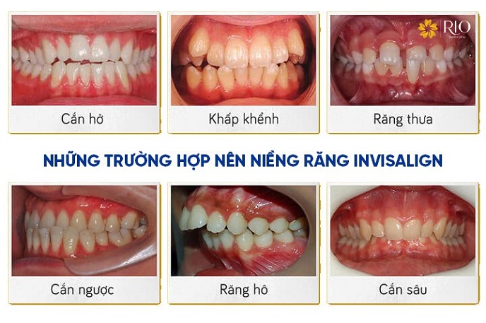 Các trường hợp nên niềng răng Invisalign