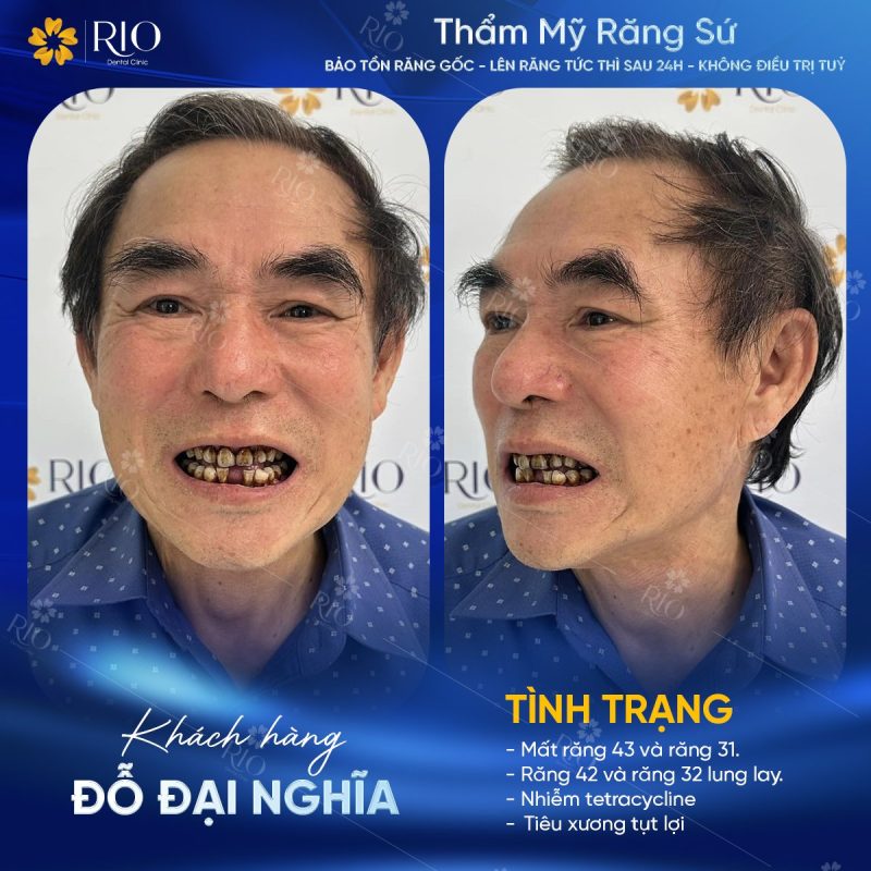 Hàm răng của ông Nghĩa bị xỉn màu, tiêu xương, tụt lợi, nhiễm kháng sinh nặng