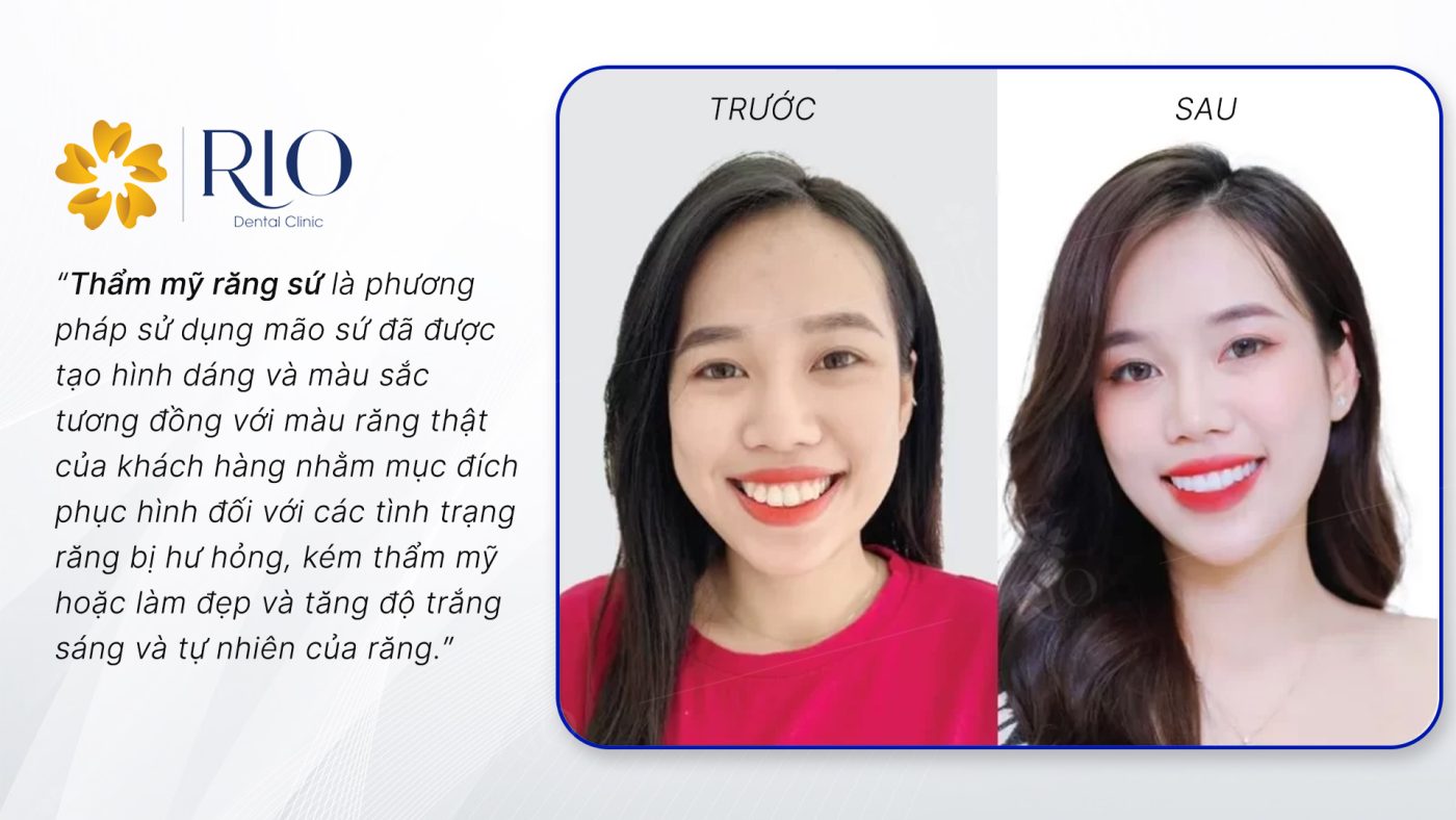 Thẩm mỹ răng sứ là gì Thẩm mỹ răng sứ là gì