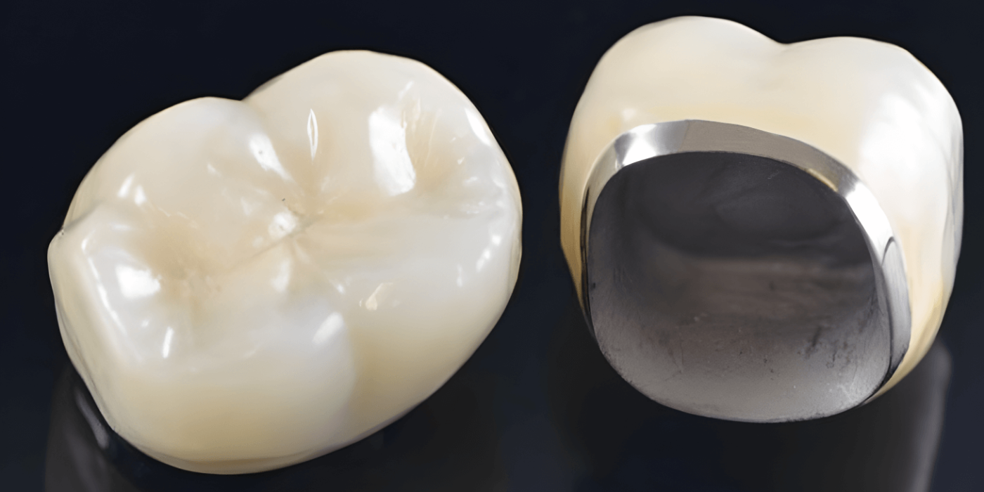 Răng sứ kim loại tính thẩm mỹ không cao, không phù hợp với răng cửa Răng sứ kim loại tính thẩm mỹ không cao, không phù hợp với răng cửa