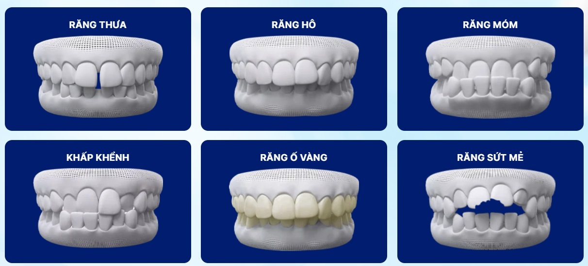 6 trường hợp được chỉ định bọc răng sứ thẩm mỹ tại Nha Khoa Rio 6 trường hợp được chỉ định bọc răng sứ thẩm mỹ tại Nha Khoa Rio