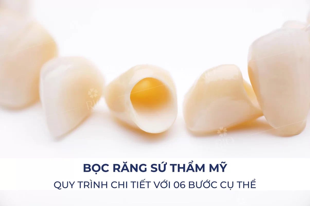 QUY-TRINH-BOC-RANG-SU-THAM-MY-06-BUOC